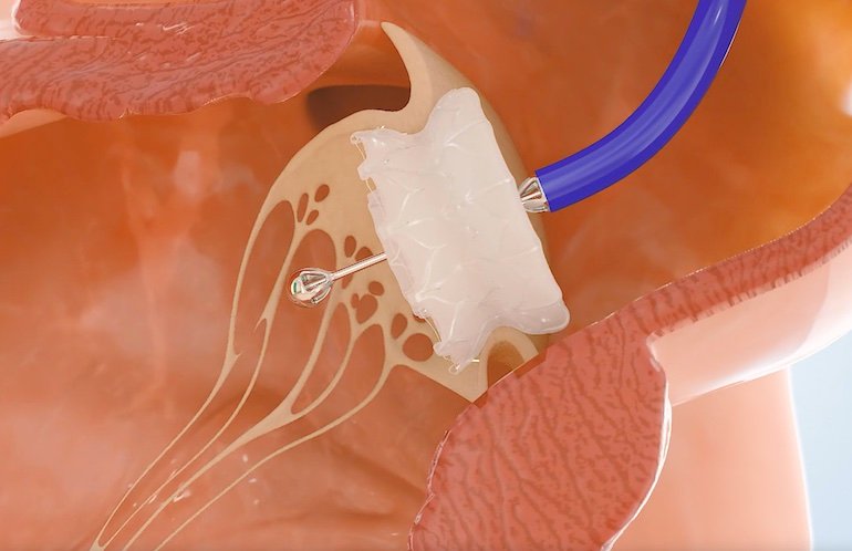  Capstan Medical completes robotic catheter mitral valve replacement